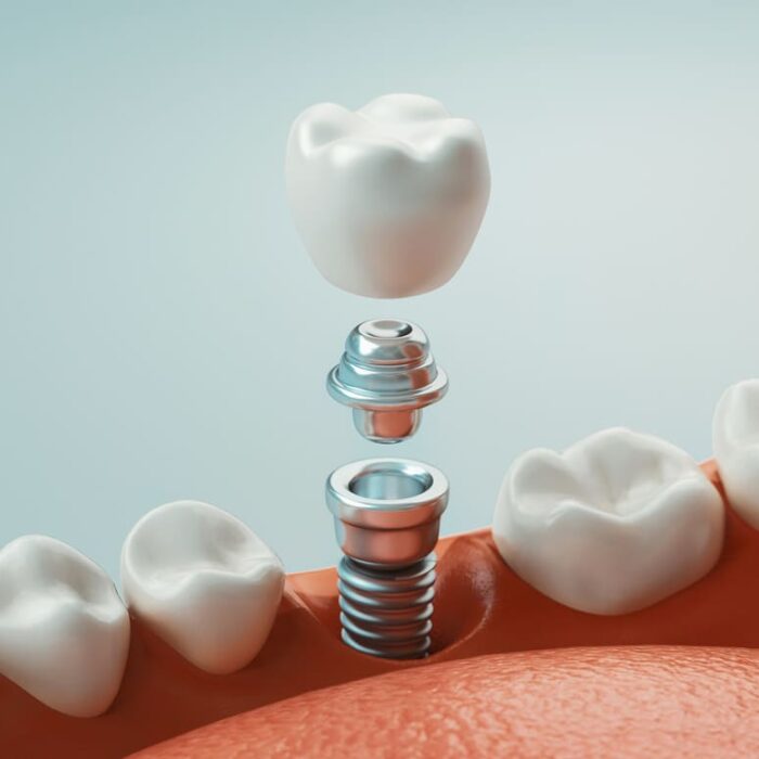 Dental Implants: Your Guide to a Restored Smile